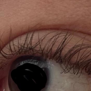 Kirpik Lifting Sonrası Aşırı Yükseliş Ve Kalıcı Hasar