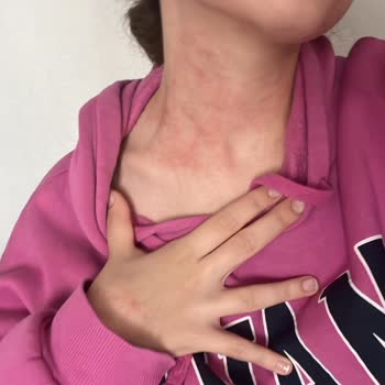 Wiwify Cilt Bakım Ürünlerinden Alerjik Reaksiyon, Sağlık Gideri Ve İade Talebi