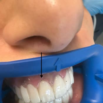 Dt. Oğuz Yıldız Gülüş Tasarımı Hayal Kırıklığı İle Sonuçlandı!