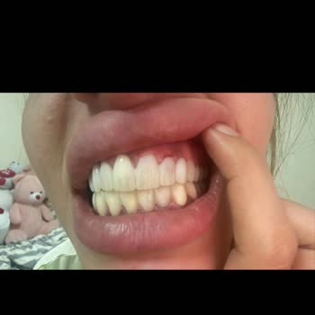 Dt. Oğuz Yıldız Gülüş Tasarımı Hayal Kırıklığı İle Sonuçlandı!