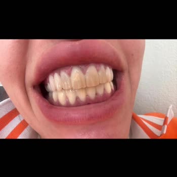 Dt. Oğuz Yıldız Gülüş Tasarımı Hayal Kırıklığı İle Sonuçlandı!