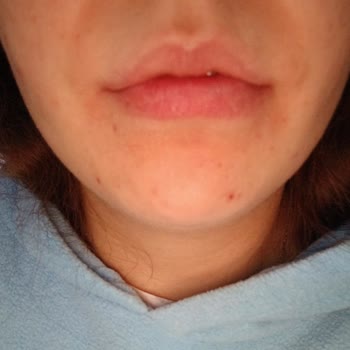 Phlab Anti Acne Ürünleri Yüzümde Şiddetli Yanma Ve Kızarıklığa Neden Oldu