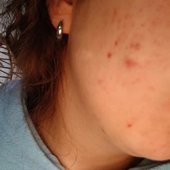 Phlab Anti Acne Ürünleri Yüzümde Şiddetli Yanma Ve Kızarıklığa Neden Oldu