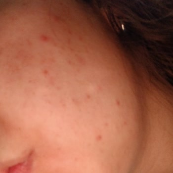 Phlab Anti Acne Ürünleri Yüzümde Şiddetli Yanma Ve Kızarıklığa Neden Oldu