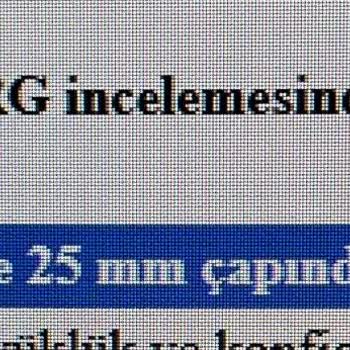 Beyin Kistinin Büyümesi Rağmen Yanlış Teşhis Ve Dideral Reçetesi