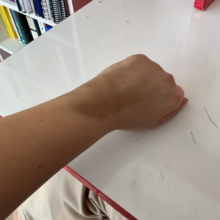 Selahaddin Eyyubi Devlet Hastanesi İlaç Damar Dışına Çıktı Ama Umursamadılar