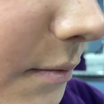 Op. Dr. Ercan Çelikkaleli Ameliyat İzleri Oluştu, Burun Deliklerimde Eşitsizlik Var