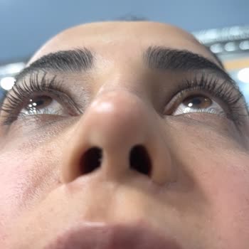 Op. Dr. Ercan Çelikkaleli Ameliyat İzleri Oluştu, Burun Deliklerimde Eşitsizlik Var