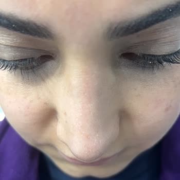 Op. Dr. Ercan Çelikkaleli Ameliyat İzleri Oluştu, Burun Deliklerimde Eşitsizlik Var