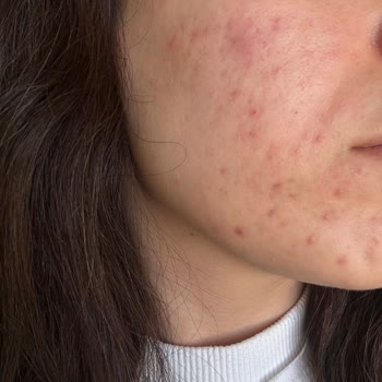 Caudalie Ürünlerinin Ciltteki Aksine Etkisi Ve Mağduriyet Talebi