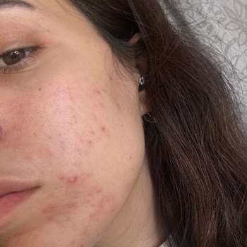 Caudalie Ürünlerinin Ciltteki Aksine Etkisi Ve Mağduriyet Talebi