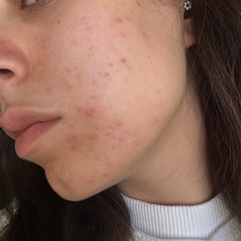 Caudalie Ürünlerinin Ciltteki Aksine Etkisi Ve Mağduriyet Talebi