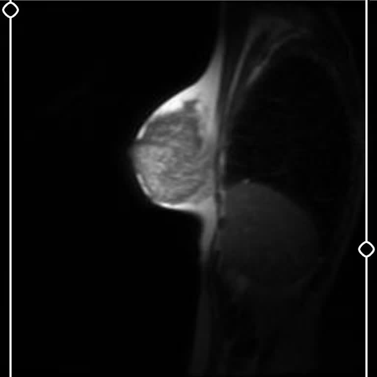 Meme MR Raporunun Gecikmesi Ve Radyoloji Biriminden Yanıt Alamama