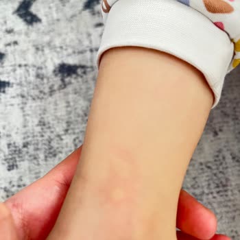 Bebek Deterjanı Ciltte Kızarıklık Ve Kabarmaya Neden Oldu İade İstiyorum