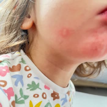 Bebek Deterjanı Ciltte Kızarıklık Ve Kabarmaya Neden Oldu İade İstiyorum