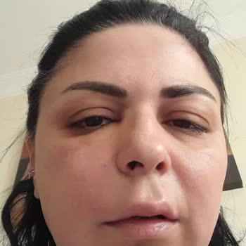 Dilan Polat Estetik Dolgu Şişliği, Çelişkili Tedavi Ve Klinik İlgisizliği