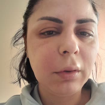 Dilan Polat Estetik Dolgu Şişliği, Çelişkili Tedavi Ve Klinik İlgisizliği