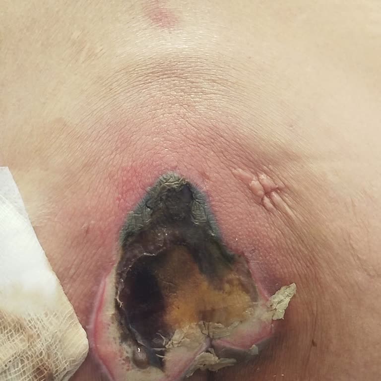 Sağlık Bakanlığı Yaşlı Hastaya Saygısız Davranış ve Yetersiz Yatak Yarası Tedavisi Şikayeti