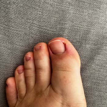 Kirpik Liftinginde Kırılma, Pedikürde Yaralanma Ve Tam İade İsteği