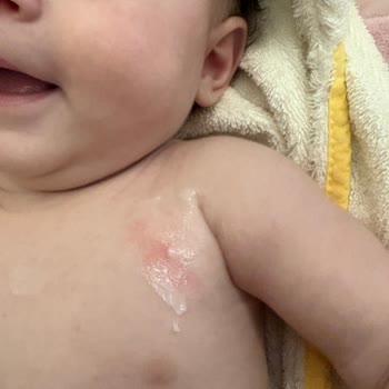 Bebek Kremi Alerjisi Nedeniyle Cilt Yanıkları Ve Ürün İadesi Talebi