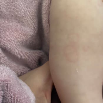 Bebek Kremi Alerjisi Nedeniyle Cilt Yanıkları Ve Ürün İadesi Talebi