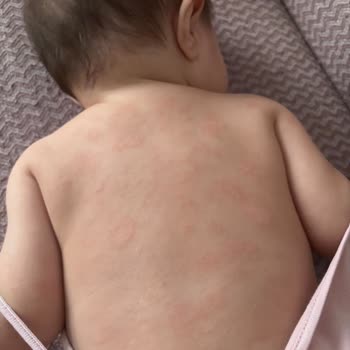 Bebek Şampuanı Kullanımı Sonrası Cilt Döküntüsü Ve Mantar Teşhisi: Açıklama Ve Geri Ödeme Talebi