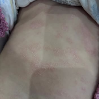 Bebek Şampuanı Kullanımı Sonrası Cilt Döküntüsü Ve Mantar Teşhisi: Açıklama Ve Geri Ödeme Talebi