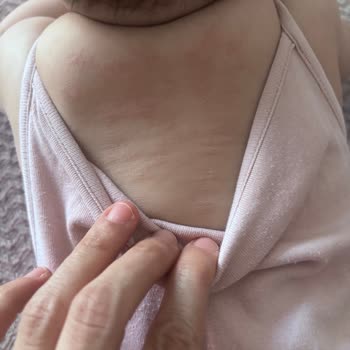 Bebek Şampuanı Kullanımı Sonrası Cilt Döküntüsü Ve Mantar Teşhisi: Açıklama Ve Geri Ödeme Talebi