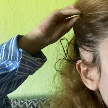 Saçkıran Hastalığı İçin Unamity İlacının Geri Ödeme Kapsamına Alınması Talebi