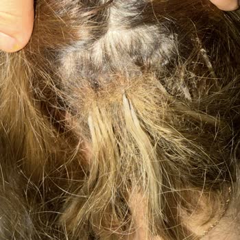 Saçkıran Hastalığı İçin Unamity İlacının Geri Ödeme Kapsamına Alınması Talebi