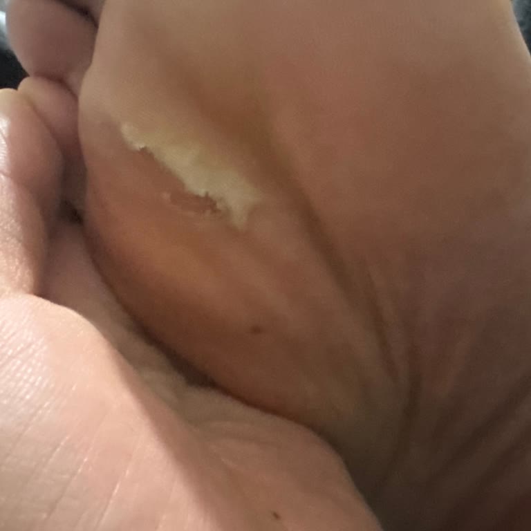 Sağlık Sorunları Nedeniyle Deichmann Adidas Superstar Ayakkabısının İadesi Talebi