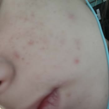 Neutrogena Nemlendiricinin Sivilceyi Artırması Ve Kullanıcı Memnuniyetsizliği