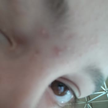 Neutrogena Nemlendiricinin Sivilceyi Artırması Ve Kullanıcı Memnuniyetsizliği