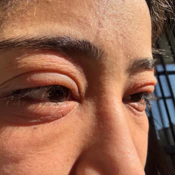 Trendyol'dan Aldığım BB Kremi Alerjik Şok Yarattı Müşteri Hizmetleri Yanıtı İlgisiz