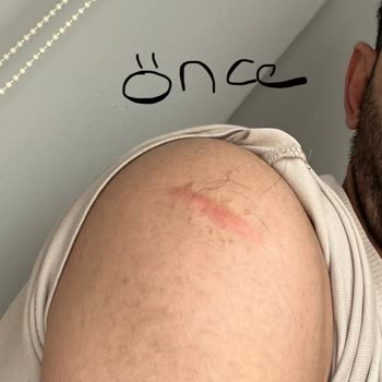 Eş Dermatoloji İşlemden Sonra İzler Azalmadığı Gibi Daha Da Belirginleşti