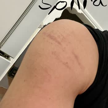 Eş Dermatoloji İşlemden Sonra İzler Azalmadığı Gibi Daha Da Belirginleşti