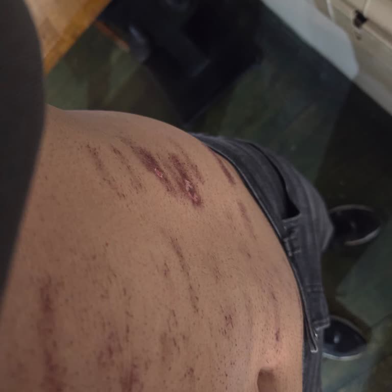 Beautyplus Cihaz Değişikliği Sonrası Yanma ve Geri Ödeme Reddi