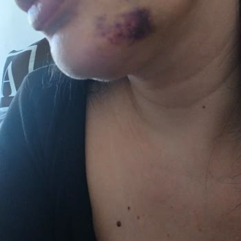 Medical World'de Hatalı Dolgu Ve İade Talebi