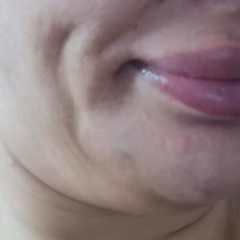 World Class Clinic’te Hatalı Dolgu Ve İade Talebinin Reddedilmesi