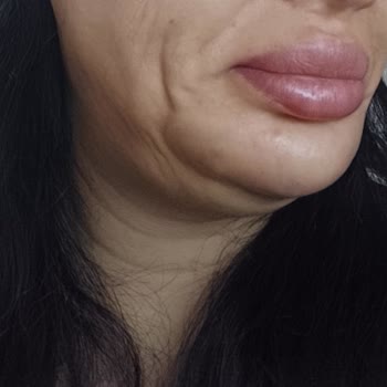 World Class Clinic’te Hatalı Dolgu Ve İade Talebinin Reddedilmesi