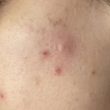 Yanıltıcı Reklam Ve Etkisiz Akne Tedavisi İçin 27.000 TL Geri İade Talebi