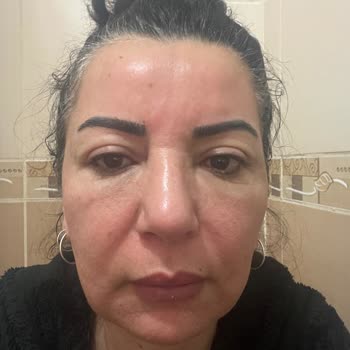 Alerjik Reaksiyon Sonrası İptal Reddi Ve Ücret İadesi Talebi