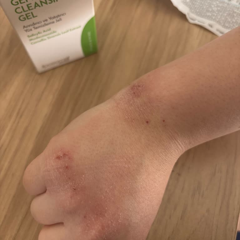 Ciltte Şiddetli Tahriş Ve Egzama, Watsons Mağazasının Çözüm Sunmaması