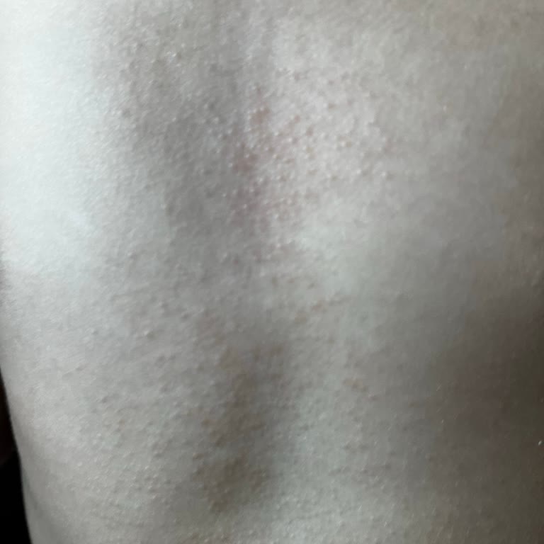 Mustela Stelatopia Kreminde Çocuk Cildinde Döküntü Endişesi