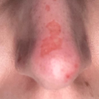 Kayseri Aris E*** D****’da Yüz Bakımı Sonrası Cilt Yanığı Ve Yetersiz Çözüm Teklifi