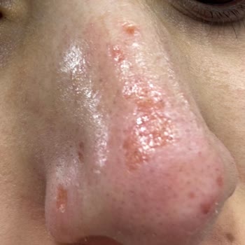 Kayseri Aris E*** D****’da Yüz Bakımı Sonrası Cilt Yanığı Ve Yetersiz Çözüm Teklifi