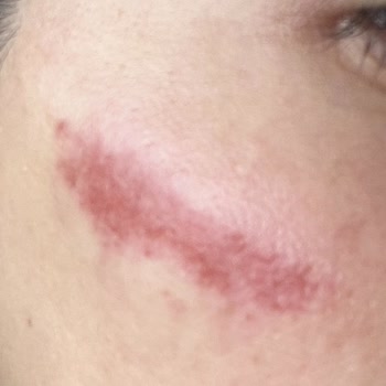 Dolgu Uygulamasında Yanık Ve Şiddetli Tahriş Sonrası Ücret İadesi Talebi