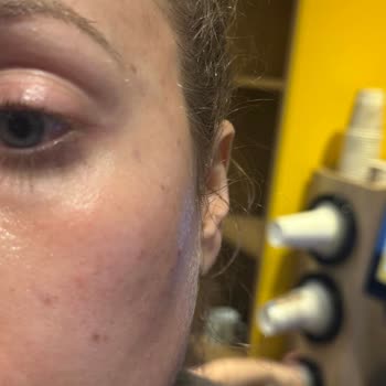 Dolgu Ve Botoks Sonrası Şiddetli Şişlik, Asimetri Ve Sorumsuz Klinik Yanıtı
