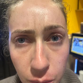 Dolgu Ve Botoks Sonrası Şiddetli Şişlik, Asimetri Ve Sorumsuz Klinik Yanıtı