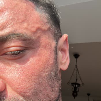 Dolgu Ve Botoks Sonrası Şiddetli Şişlik, Asimetri Ve Sorumsuz Klinik Yanıtı